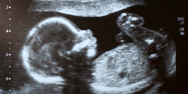 An ultrasound of a fetus is shown.