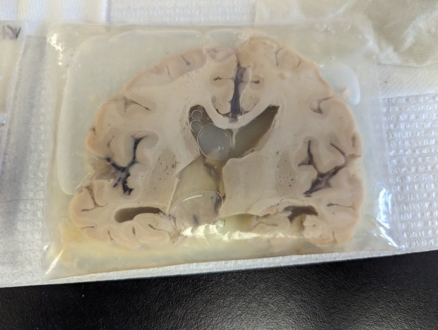 Human brain, UC Irvine's Institute for Memory Impairments and Neurological Disorders (UCI MIND). (Photo by Teri Sforza, Orange County Register/SCNG)